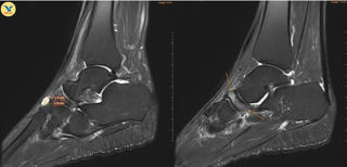 Đau khớp cổ chân khởi phát không rõ nguyên nhân, đi khám phát hiện Hội chứng Mueller-Weiss hiếm gặp