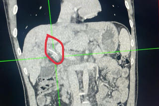 Kịp thời cứu sống bệnh nhân bị xương cá dài 3cm xuyên vào đường mật