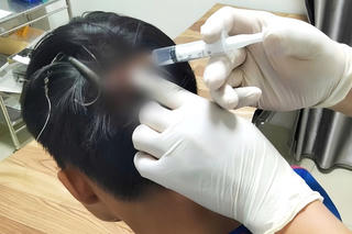 Thiếu niên 15 tuổi bị móc 3 tiêu cắm vào đỉnh đầu khi câu cá