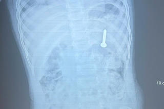 Cứu kịp thời bệnh nhi 21 tháng tuổi nuốt đinh vít sắc nhọn