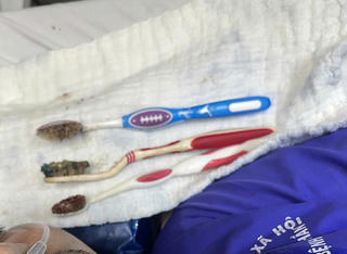 Bệnh viện Trung ương Huế nội soi lấy 3 bàn chải đánh răng khỏi đường tiêu hóa bệnh nhân