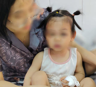 Cấp cứu kịp thời giữ lại khuôn mặt cho bé gái 22 tháng tuổi bị chó cắn