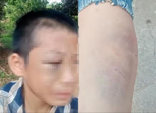 Xác minh clip bé trai bầm tím mặt, nghi do bị bạo hành