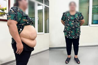 10 lần mang thai dang dở và hành trình giảm 34kg sau 9 tháng nhờ phẫu thuật thu nhỏ dạ dày