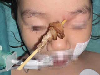 Bệnh viện Hữu nghị Việt Đức: Cứu thành công bé gái bị que xiên thịt cắm lên hốc mắt
