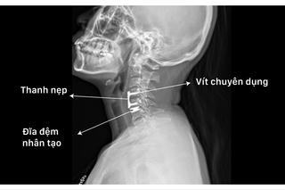 Tưởng đau cổ vai gáy, không ngờ tủy sống bị chèn ép vì thoát vị đĩa đệm