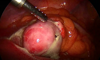 Phẫu thuật thành công bệnh nhân thủng khối u GIST ruột non hiếm gặp