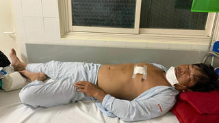 Mâu thuẫn trong tranh chấp đất đai, người anh dùng kéo đâm trọng thương em trai