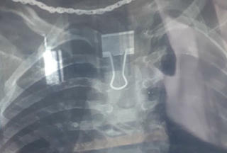 Tá hỏa kẹp giấy 'kẹt' trong thực quản bé gái 2 tuổi