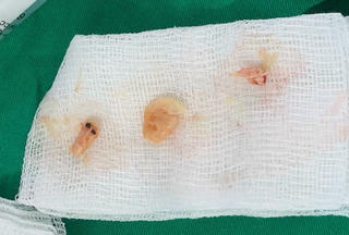 Những đồ vật nhỏ làm gia tăng hóc dị vật đường thở ở trẻ em 