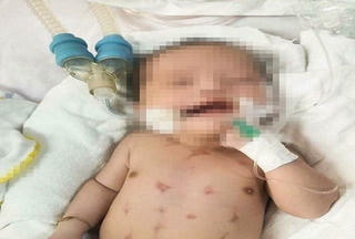 Trẻ 16 ngày tuổi nguy kịch sau khi được xông than, chích đẹn 