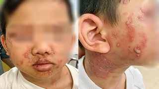 Trẻ 5 tuổi bị kiến ba khoang cắn, bác sĩ cảnh báo những nguy hiểm 