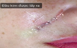 Tiêm filler tại tiệm làm tóc, người phụ nữ bị kim gãy cắm sâu trong má