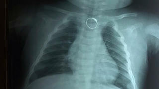 Bé 2 tháng tuổi nuốt chiếc nhẫn vàng đeo trên ngón tay