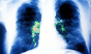 Cách phòng ngừa bệnh viêm phổi do khuẩn Legionella gây nên