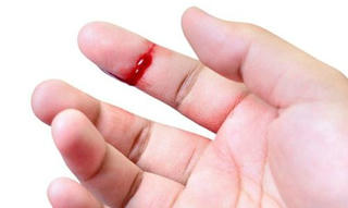Làm gì khi xử lý vết thương cho người bị bệnh máu khó đông