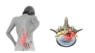 Cải thiện thoát vị đĩa đệm cột sống thắt lưng hiệu quả, an toàn nhờ Cốt Thoái Vương