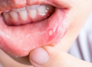 TẠI SAO NGƯỜI BỊ NHIỆT MIỆNG LƯỠI, NHIỆT LỢI NÊN DÙNG GUMIMOUTH?