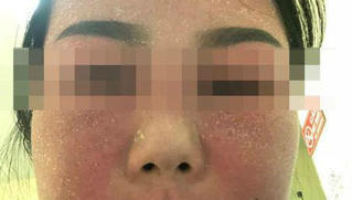 Sử dụng mỹ phẩm trắng da cô gái phải nhập viện cấp cứu