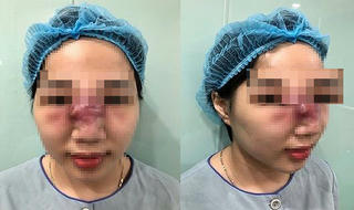 Nguy cơ hoại tử mũi vì tiêm filler tại spa