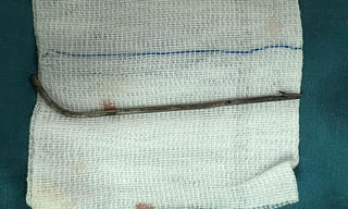 Cứu sống nam thanh niên bị mũi tên bắn cá đâm xuyên vào tuỷ