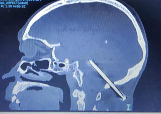 Dị vật đâm qua xương sọ bệnh nhân cả năm mà không biết 