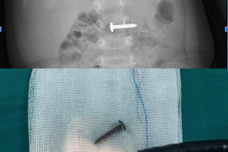 Cứu cháu bé nuốt đinh vít vào bụng