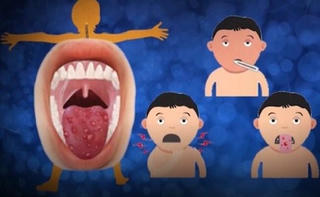 Bệnh tay chân miệng ở trẻ và giải pháp hay từ bộ đôi thảo dược