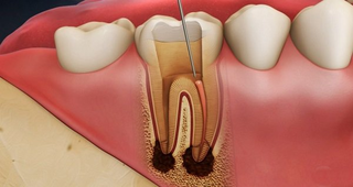Cải thiện viêm lợi kéo dài nhờ dung dịch nha khoa Nutridentiz