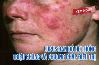 Lupus ban đỏ hệ thống – Triệu chứng và phương pháp điều trị