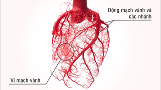 Bệnh mạch vành: Giải pháp nào hỗ trợ cải thiện đau tức ngực, thiếu máu tim?