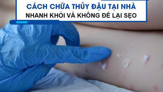 Cách chữa thủy đậu tại nhà nhanh khỏi và không để lại sẹo