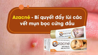 Những điều cần biết về mụn trứng cá và cách phòng ngừa hiệu quả