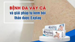 Bệnh da vảy cá và giải pháp từ kem bôi thảo dược Explaq