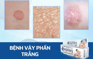 Bệnh vảy phấn trắng và cách cải thiện triệu chứng hiệu quả nhờ kem bôi Explaq