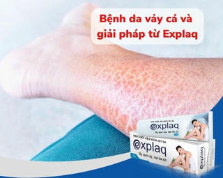 Có kem dược liệu Explaq, ngại gì da vảy cá mọc mùa đông!