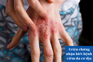 Triệu chứng nhận biết viêm da cơ địa và giải pháp cải thiện nhờ kem làm sạch da Eczestop