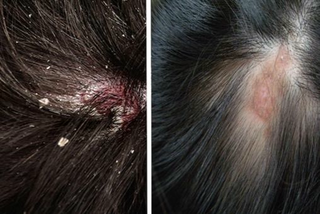 Gàu, nấm da đầu: Cảnh báo nguy cơ gây rụng tóc và cách cải thiện hiệu quả
