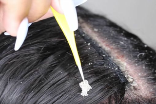 Cách chọn dầu gội trị gàu hiệu quả nhanh, chấm dứt gàu ngứa