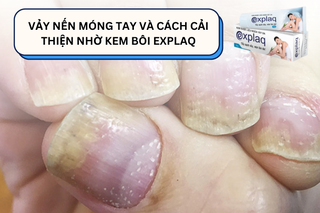 Vảy nến móng tay và cách cải thiện nhờ kem bôi Explaq