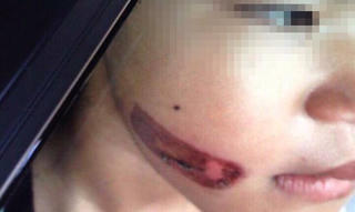 Công an điều tra nghi án bé gái bị cha dí sắt nóng vào mặt