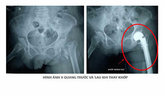Thay khớp nhân tạo thành công cho bệnh nhân 101 tuổi