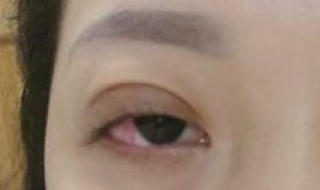 Cô gái vĩnh viễn không thể nhắm mắt sau khi cắt mí làm đẹp