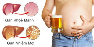 Tại sao không béo vẫn bị gan nhiễm mỡ?