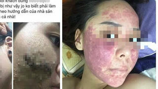 Cảnh báo: Nhập viện vì chứng "nghiện corticoid" do lạm dụng mỹ phẩm làm sáng da