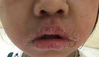 Dấu hiệu nhiễm trùng da cấp tính dễ nhầm cảm cúm