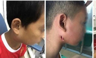 Bệnh Whitmore ăn mòn cơ thể có lây từ người sang người?