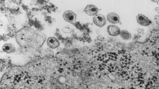 Bác sĩ Việt Nam nói gì về chủng virus HIV mới?