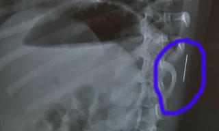 Bé gái 3 tuổi sốt cao, bác sỹ phát hiện chiếc kim khâu 'đi lạc' trong cơ thể