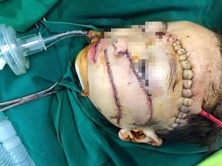 Cháu bé bị cha chém nguy kịch thoát chết với gần 300 mũi khâu 